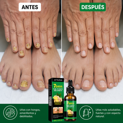 Tratamiento para Hongos en Uñas – Pies y Manos (30 ml)